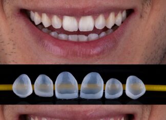 Cada vez mais populares, lentes de contato dental existem há quase um século