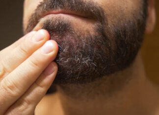 O que fazer para acabar com a coceira na barba?