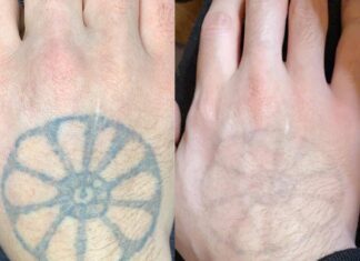 Especialista esclarece dúvidas sobre remoção de tatuagem